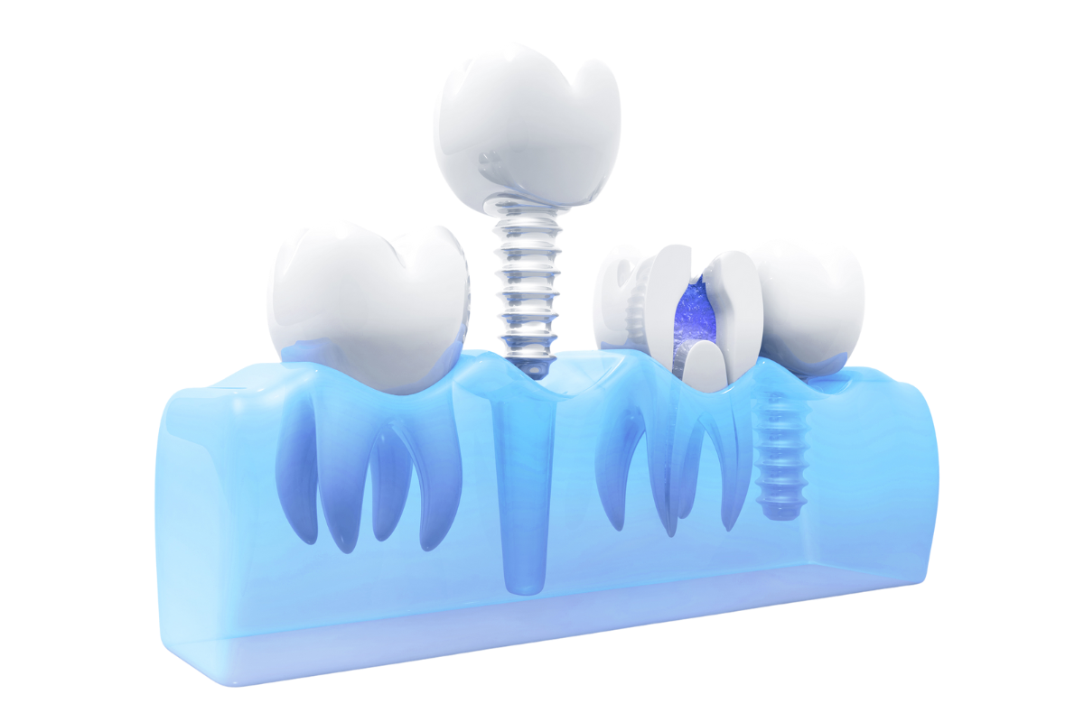 dental implant03