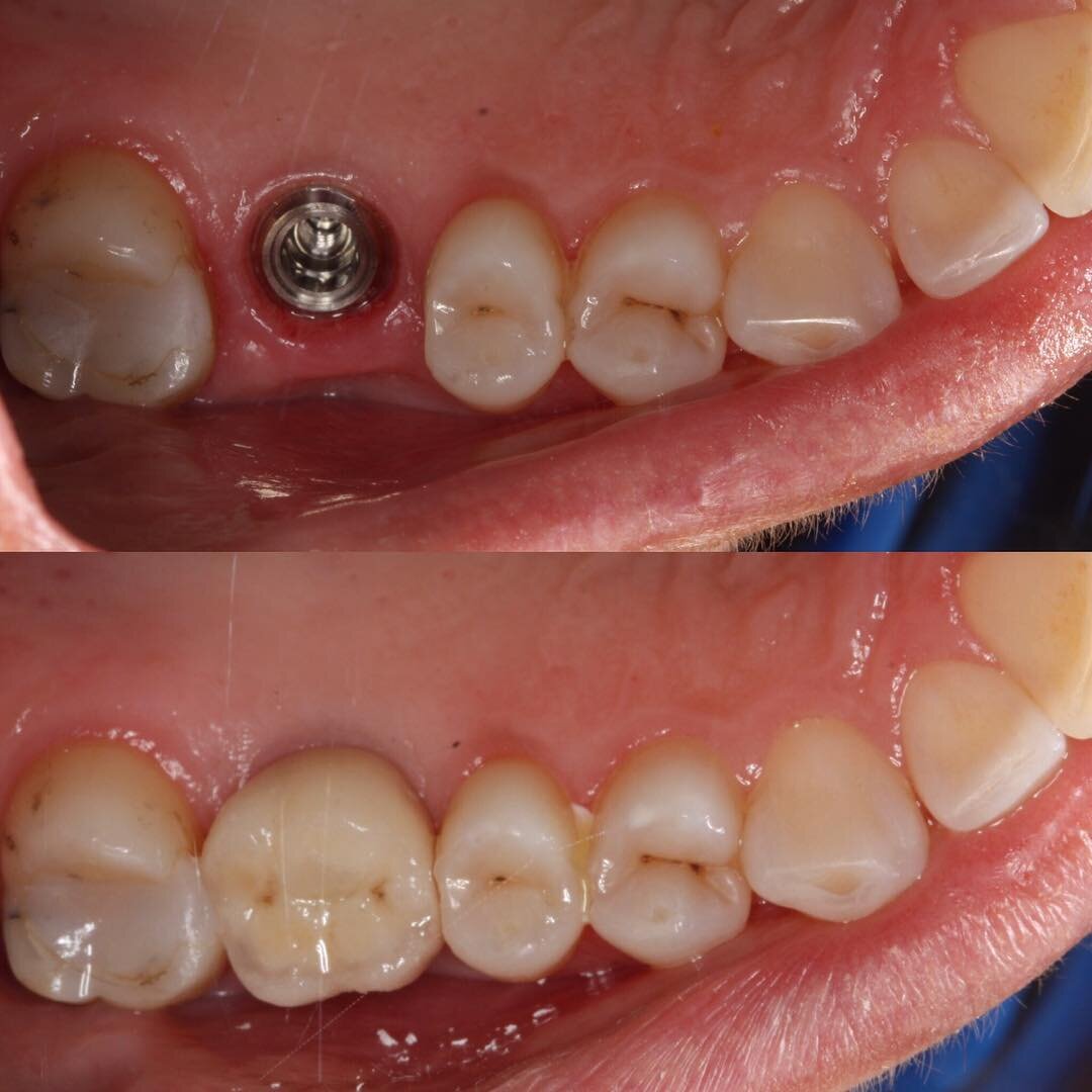 dental implant 001