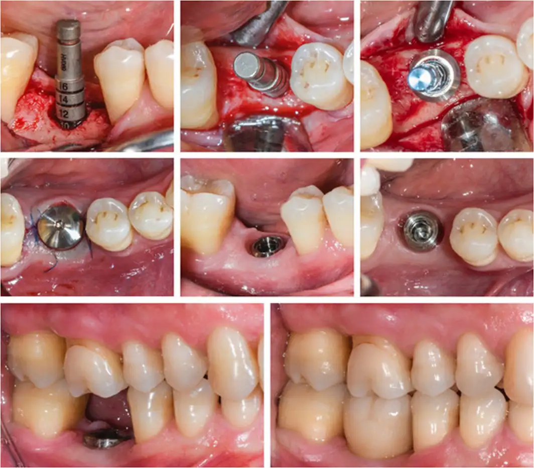 dental implant 0012 c