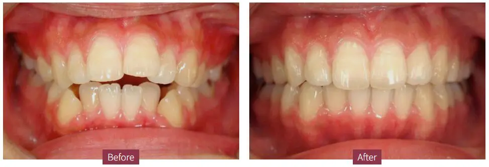 隱適美 2 invisalign case ba 1 1