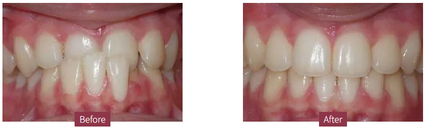 隱適美 1 invisalign case ba 2