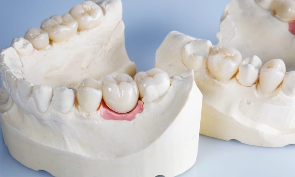 All Ceramic Crown02