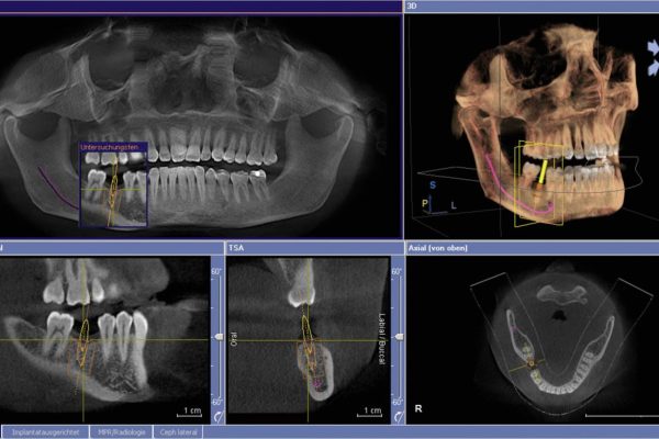 植牙數位3D電腦診斷